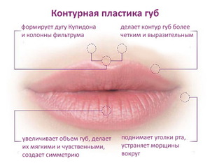 Стоит ли увеличить губы гиалуроновой кислотой.