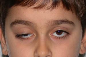 Врожденные глазные болезни