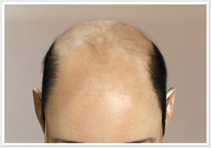 Факторы влияющие на выпадение волос