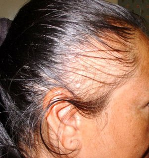 Себорея как причина выпадения волос