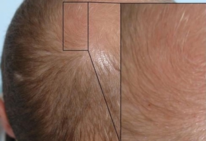 Пациент обратился с жалобами на истончение волос, потерю ими цвета и постепенное их выпадение