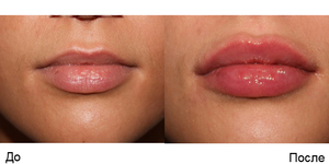 Контурная пластика губ: до и после процедуры