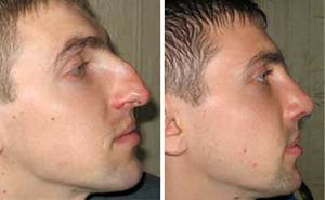 Сложности  операций по исправлению носа