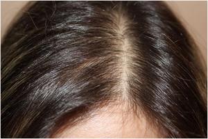 Выпадение волос при нехватке железа