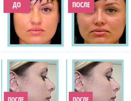 Результаты применения лангетки для коррекции формы носа
