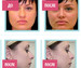 Результаты применения лангетки для коррекции формы носа
