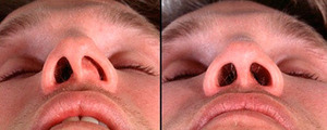 Септопластика - операция по исправлению носовой перегородки 