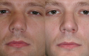 До и после коррекции носовой перегородки