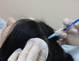 Мезотерапия для волос - проведение