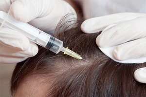 Мезотерапия для волос: отзывы