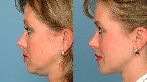 Часто используется комплекс процедур, одновременно, с липосакцией лица, щек