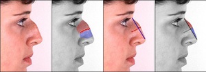 Как корректируют нос