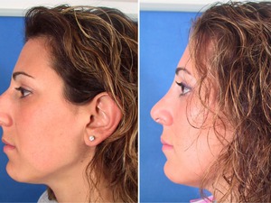 Операция по исправлению формы носа