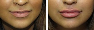 Увеличение губ и коррекцию формы губ как сделать