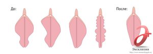Коррекция половых губ