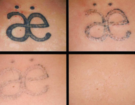 Удаление татуировок лазером: фото до и после, отзывы прошедших процедуру