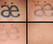 Удаление татуировок лазером: фото до и после, отзывы прошедших процедуру