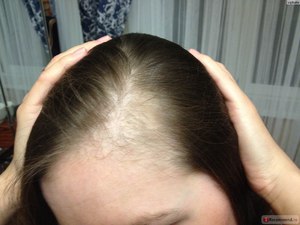 Почему выпадают волосы